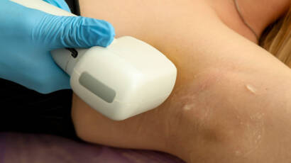 Shalom Permanent Laser Hair removal